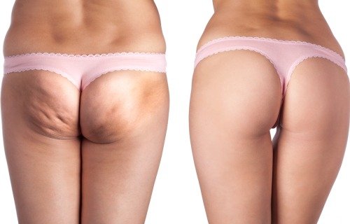 Celulitis